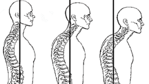 Forward-Head-Posture